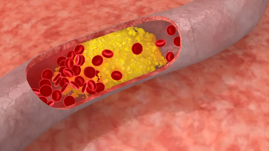 Cholesterol in blood. 