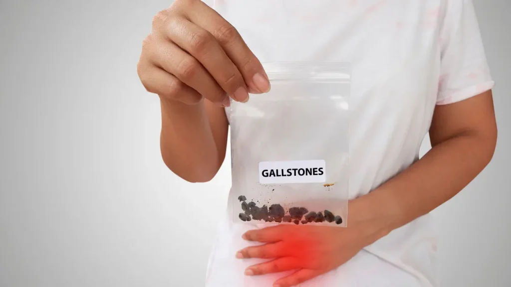 Gallstones. 