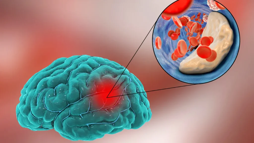 Brain inflammation. 